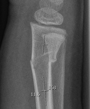 Greenstick Fracture Lateral
